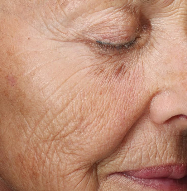 Skin aging